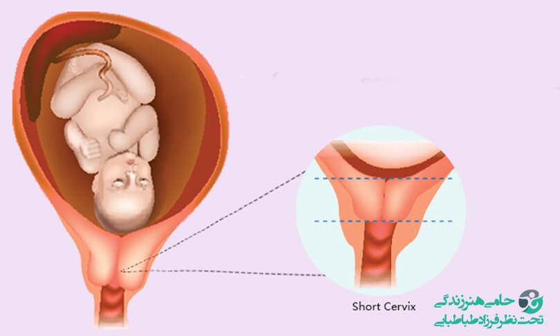 علائم نارسایی دهانه رحم در بارداری