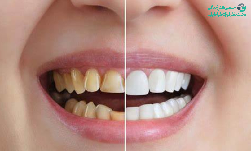 ضرر مصرف شیشه برای دندان ها