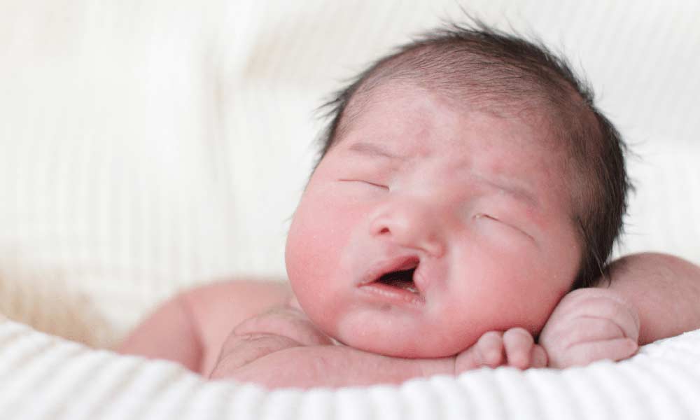 لب شکری نوزاد | علل بیماری لب شکری و روش‌های پیشگیری و درمان