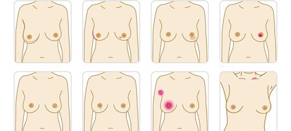 نشانه ها و علائم سرطان سینه