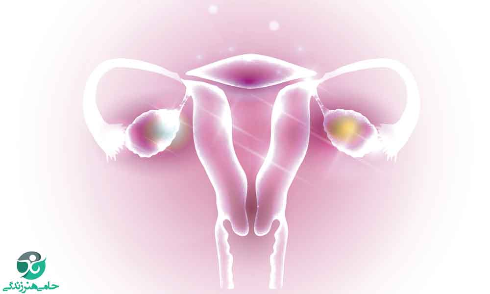 تنبلی تخمدان یا سندروم تخمدان پلی کیستیک | علل، علائم و درمان
