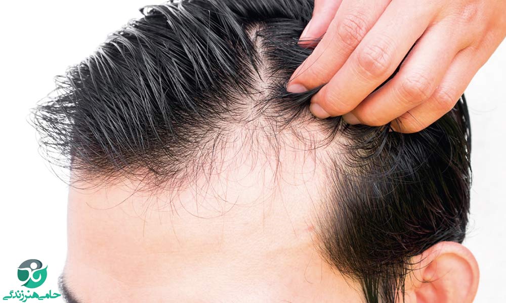 ریزش سکه ای مو | نشانه‌ها، علل و درمان طاسی منطقه ای