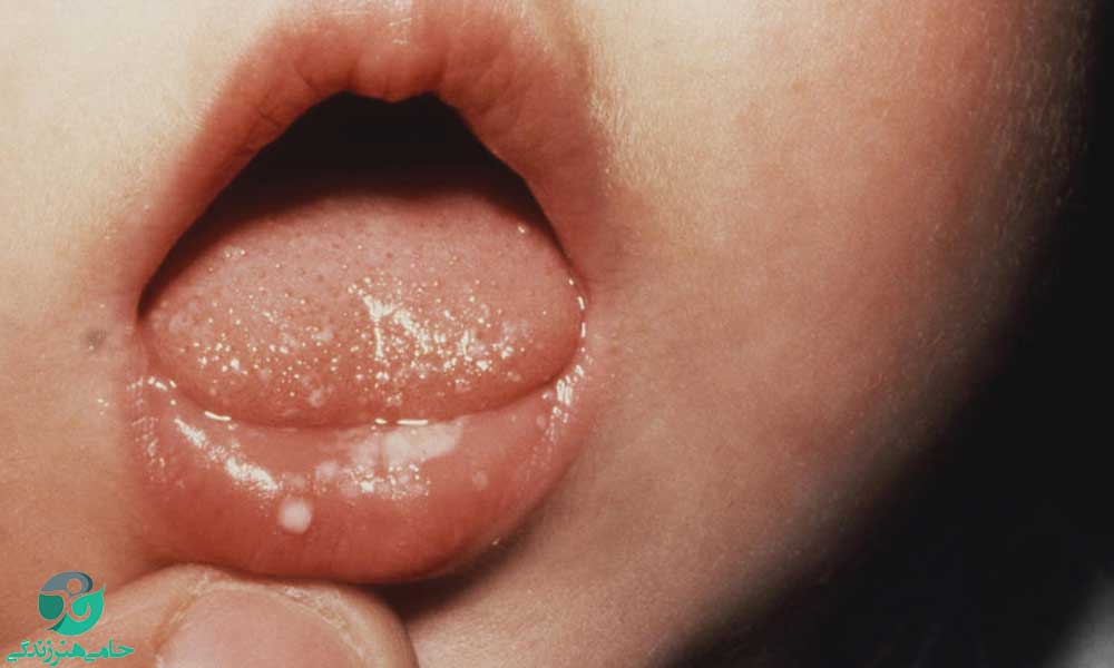 برفک دهان نوزاد | علت خوب نشدن و درمان برفک دهان نوزاد