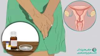 درمان عفونت قارچی واژن با روش های گیاهی و خانگی
