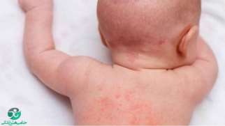 بیماری پوستی کودکان | آشنایی با شایع ترین بیماری های پوستی در کودکان