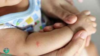 نیش پشه در کودکان | علائم، پیشگیری و درمان گزیدگی در کودک